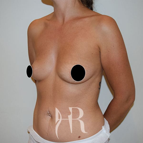 HR Plastic Surgery - Breast Enlargement patient before 2